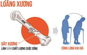7 điều ít người biết về loãng xương