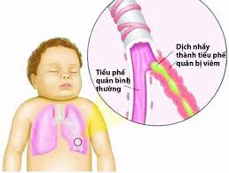 Viêm phế quản co thắt ở trẻ em